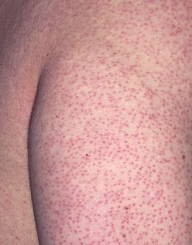 Dermatita Atopica Cauze Simptome Preventie Tratament