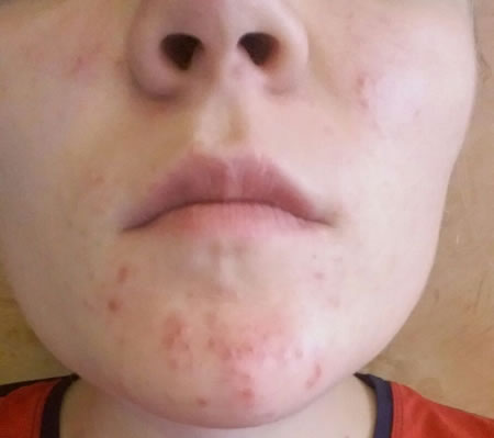 acnee leziuni