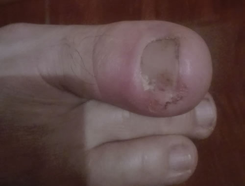 infectie unghie